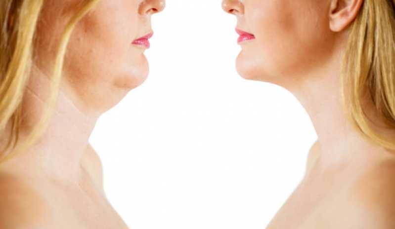 Onde Fazer Tratamento de Flacidez Facial Ipiranga - Tratamento Rejuvenescedor para o Rosto