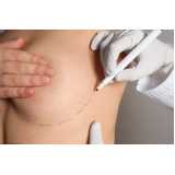 clínica que faz mamoplastia levantamento Santana do Parnaíba