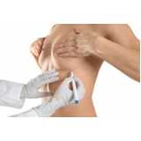 mamoplastia levantamento Mutinga