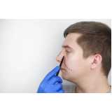 rinoplastia diminuir o nariz Remédios